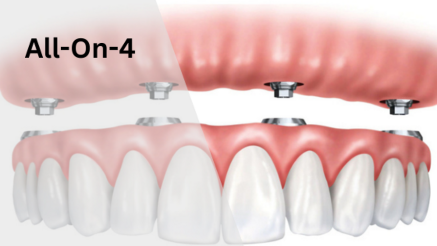 All on 4 dental implants San Antonio TX