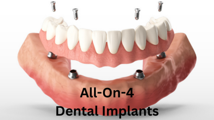 All on 4 dental implants San Antonio