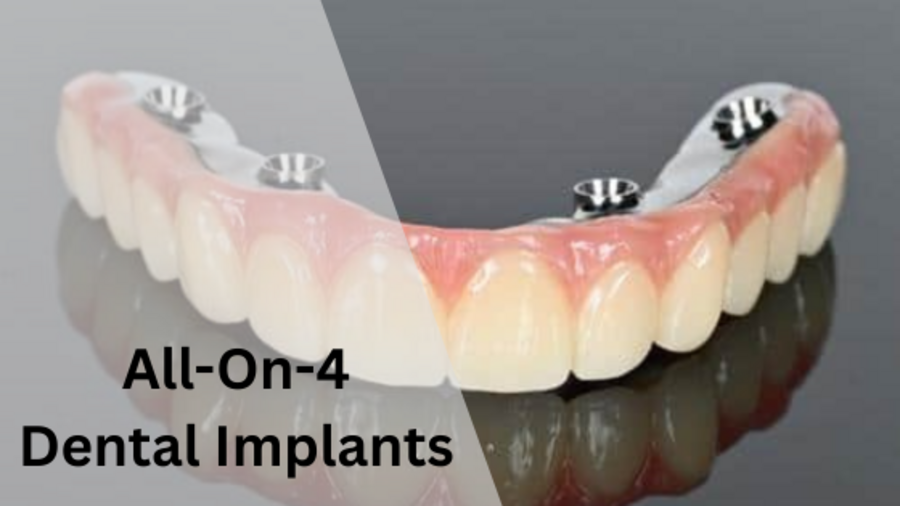 All-on-4 dental implants San Antonio