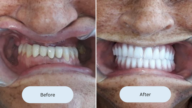 all on 4 dental implants san antonio