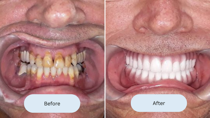 all on 4 implants san antonio