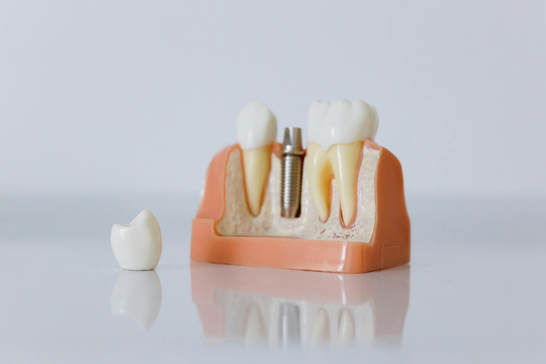dental implants for seniors with bone loss options overview and key insights